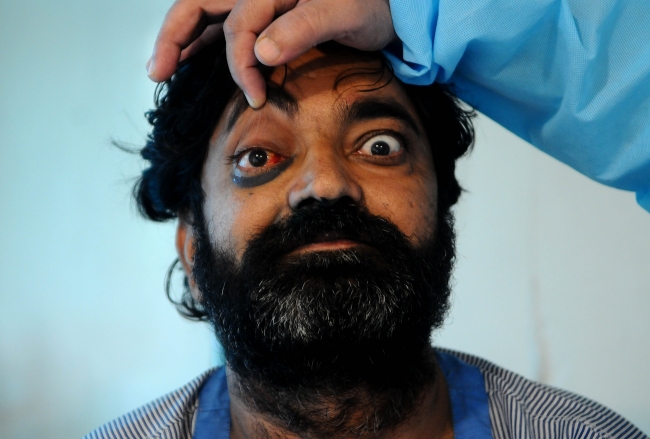 Siyah mantar hastalığı nedeniyle tedavi gören bir Hintli - Fotoğraf: AA