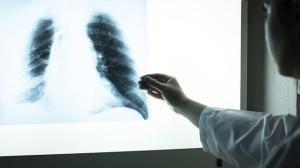 Erkekler, kadınlara göre 3,5 kat daha fazla akciğer kanserine yakalanıyor
