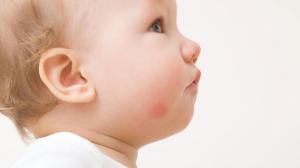 Bebeklerde ve çocuklarda besin alerjileri arttı