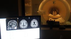 COVID-19 geçirenlerin beyin boyutunda küçülme gözlemlendi