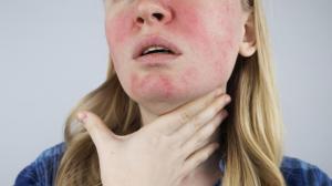 Soğuk alerjisi deyip ihmal etmeyin