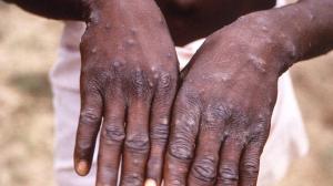 UNICEF: Burundi'deki maymun çiçeği vakalarının yüzde 30'u 5 yaş altı çocuklardan oluşuyor