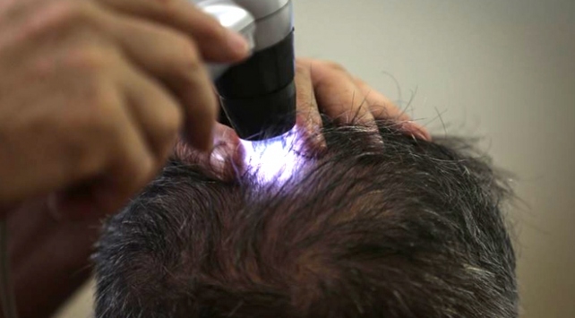 Saç dökülmesinin üç aydan uzun sürmesi hastalık habercisi