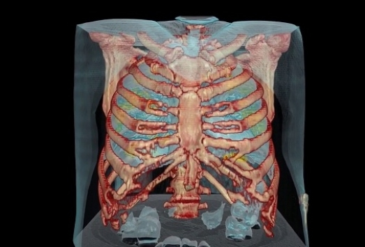 COVID-19 akciğerlere nasıl zarar veriyor?