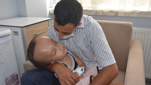 Doğuştan hidrosefali hastası bebek ameliyat edildi