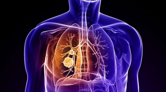 Akciğer kanseri saatte 20 can alıyor