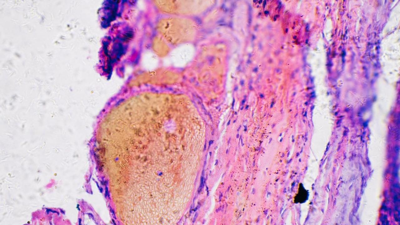 Cilt kanserinde mRNA aşısı umudu