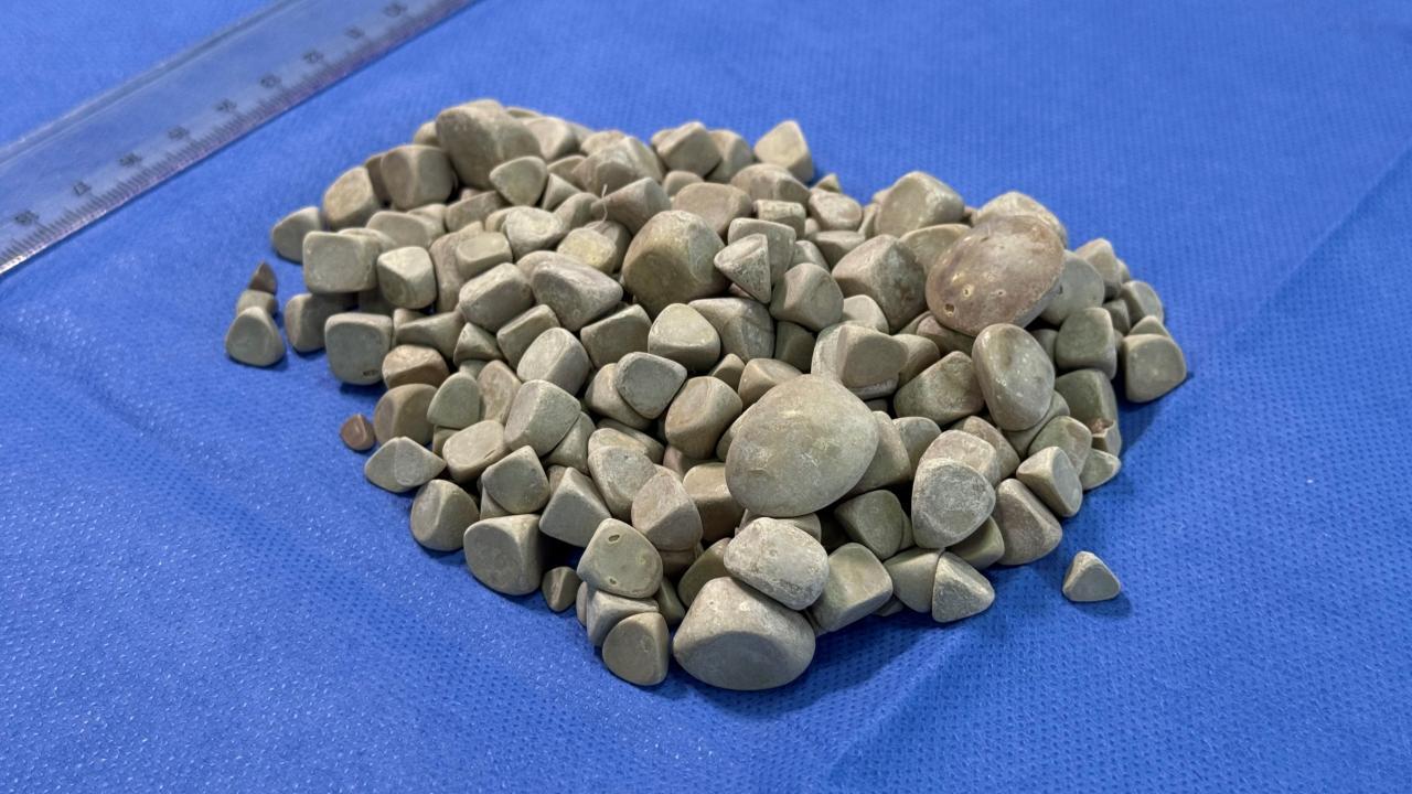 Vücudundan 287 tane taş çıkarıldı