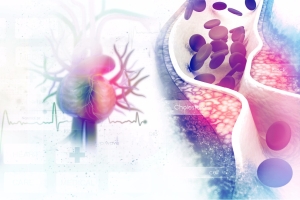 İlaçlı Stent Uygulamaları