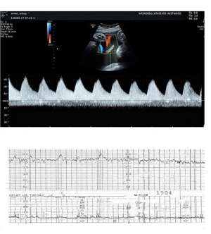 Fetal Biyofizik Profili - Doppler Ultrasonografi