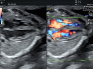 Fetal Ekokardiyografi - Fetal Kalp Muayenesi