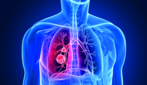 Akciğer Kanseri, Belirtileri ve Tedavisi